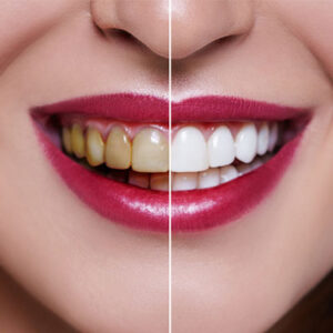 Before and after teeth whitening comparison, showing stained teeth transforming to a bright white smile.