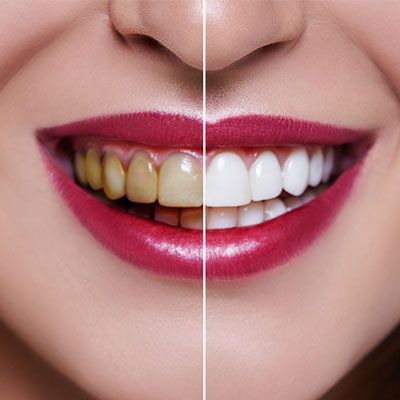 The Ultimate Guide to Teeth Whitening: Facts and Myths