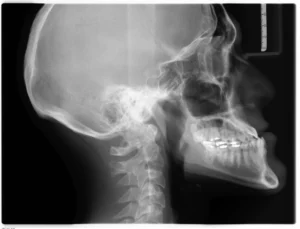 dental implant failure x-ray